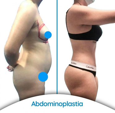 Slider image (7) Dr. Alvaro Uribe - Plastic Surgery in Colombia